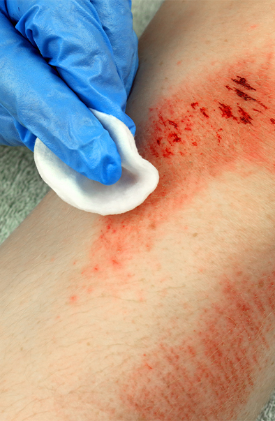 Understanding Abrasions