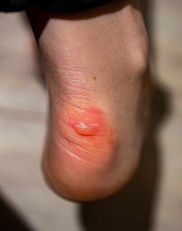 Understanding Blisters