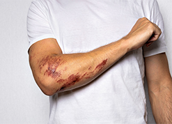 Abrasions and Skin Burns