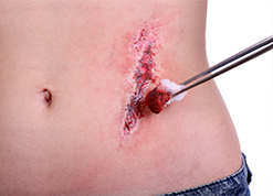 Ulsers and Traumatic Tears