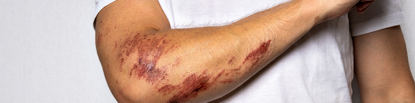 Our Services-Abrasions.jpg