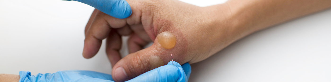 Our Services-Blisters.jpg