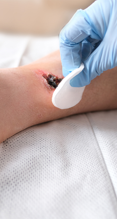 Wound Treatments